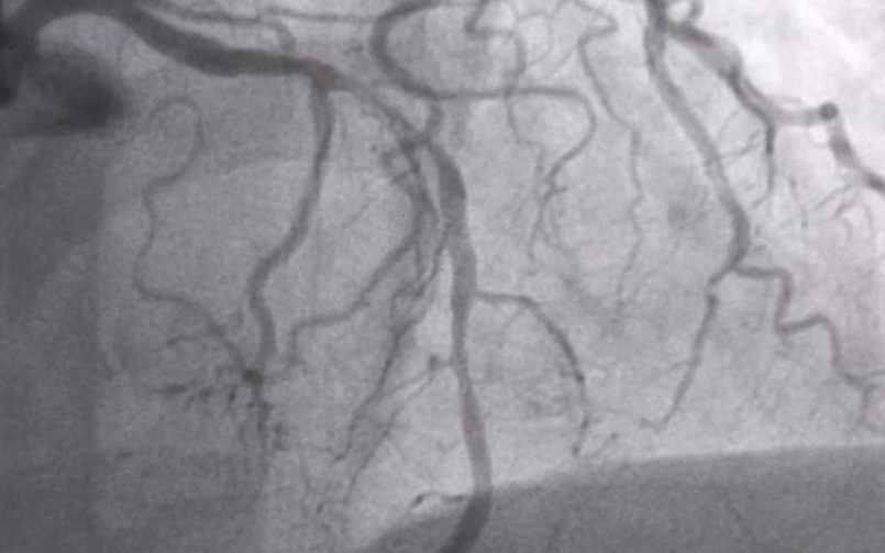 Angioplasty
